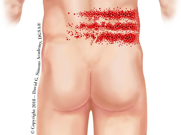 Referred Pain Pattern des M. rectus abdominis